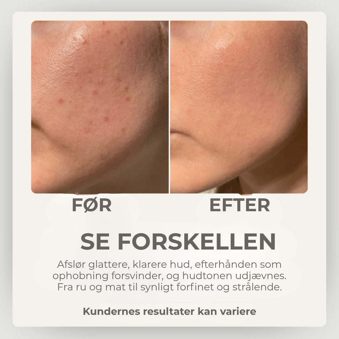 StrålendeHud® | Sig Farvel til Urenheder – Hej til Strålende Hud!