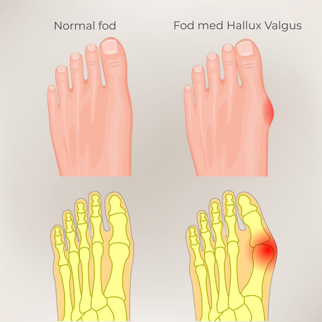 FlexiToe® | Skånsom tåjustering for daglig lindring