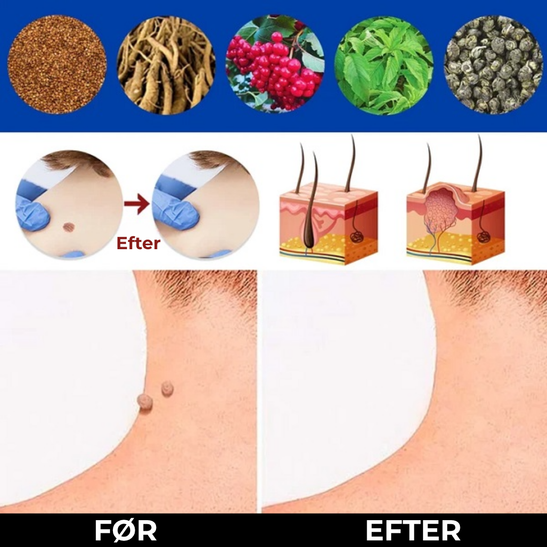 WartFri®