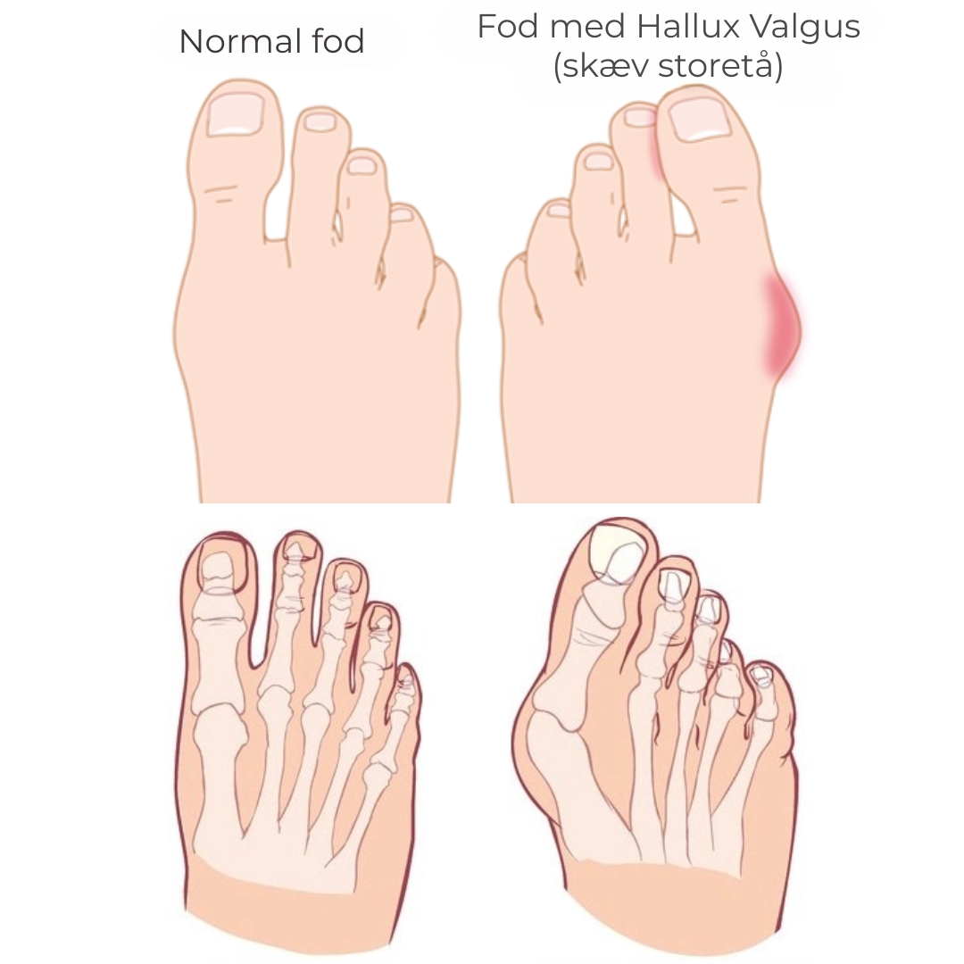FlexiToe® | Skånsom tåjustering for daglig lindring