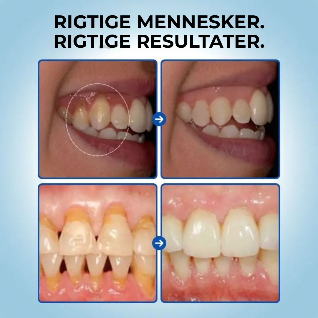 TandRo® | Stop tandkøbsretraktion naturligt, smertefrit og på kun 3 dage!