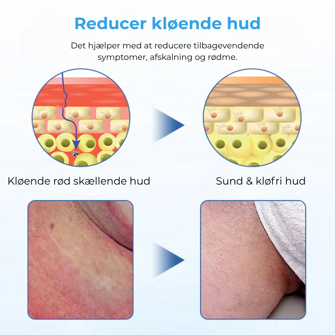 VerruRo® Wart Relief Cream | Bekæmp vorter ved roden – Skånsom, hurtigtvirkende og klinisk dokumenteret