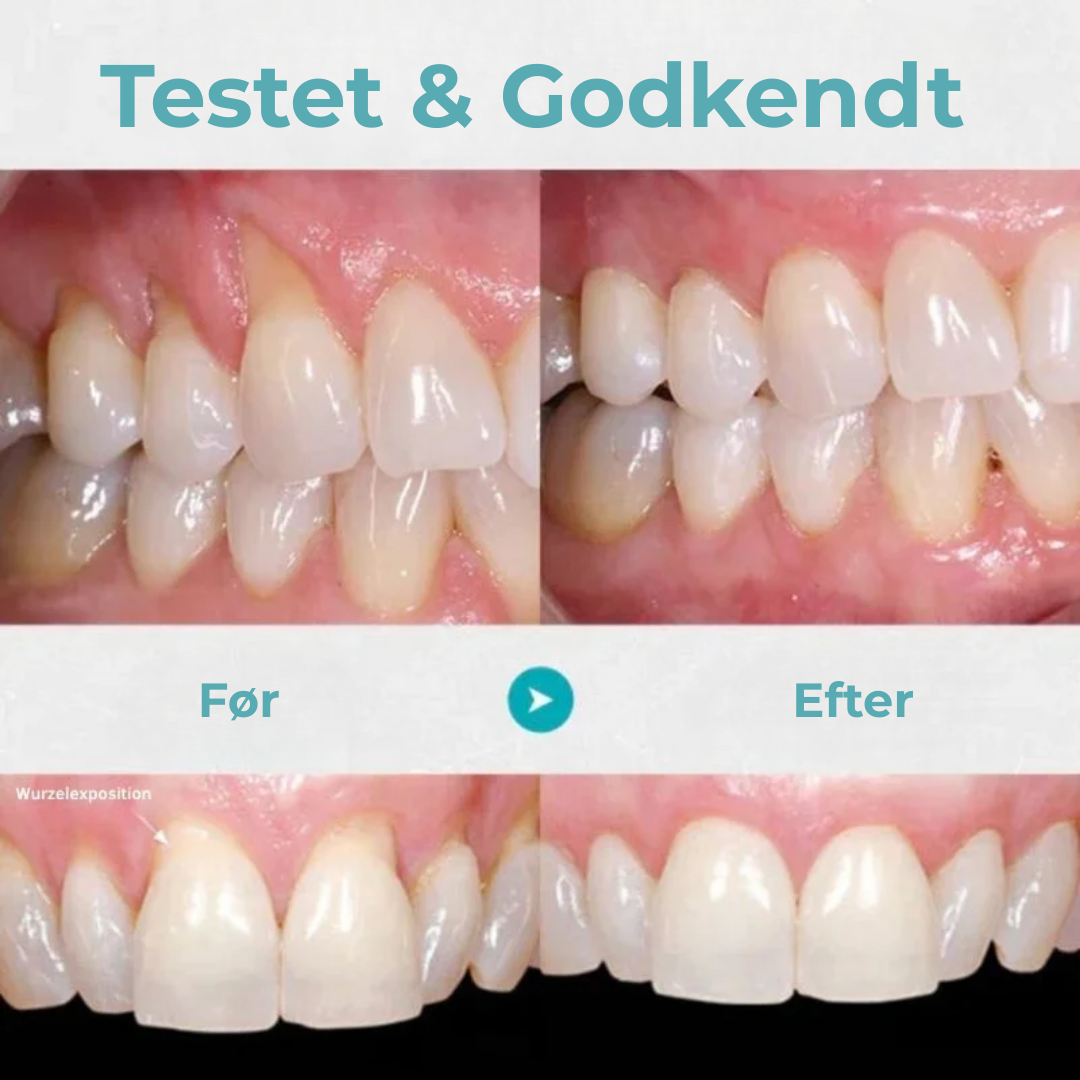 TandRo® | Stop tandkøbsretraktion naturligt, smertefrit og på kun 3 dage!