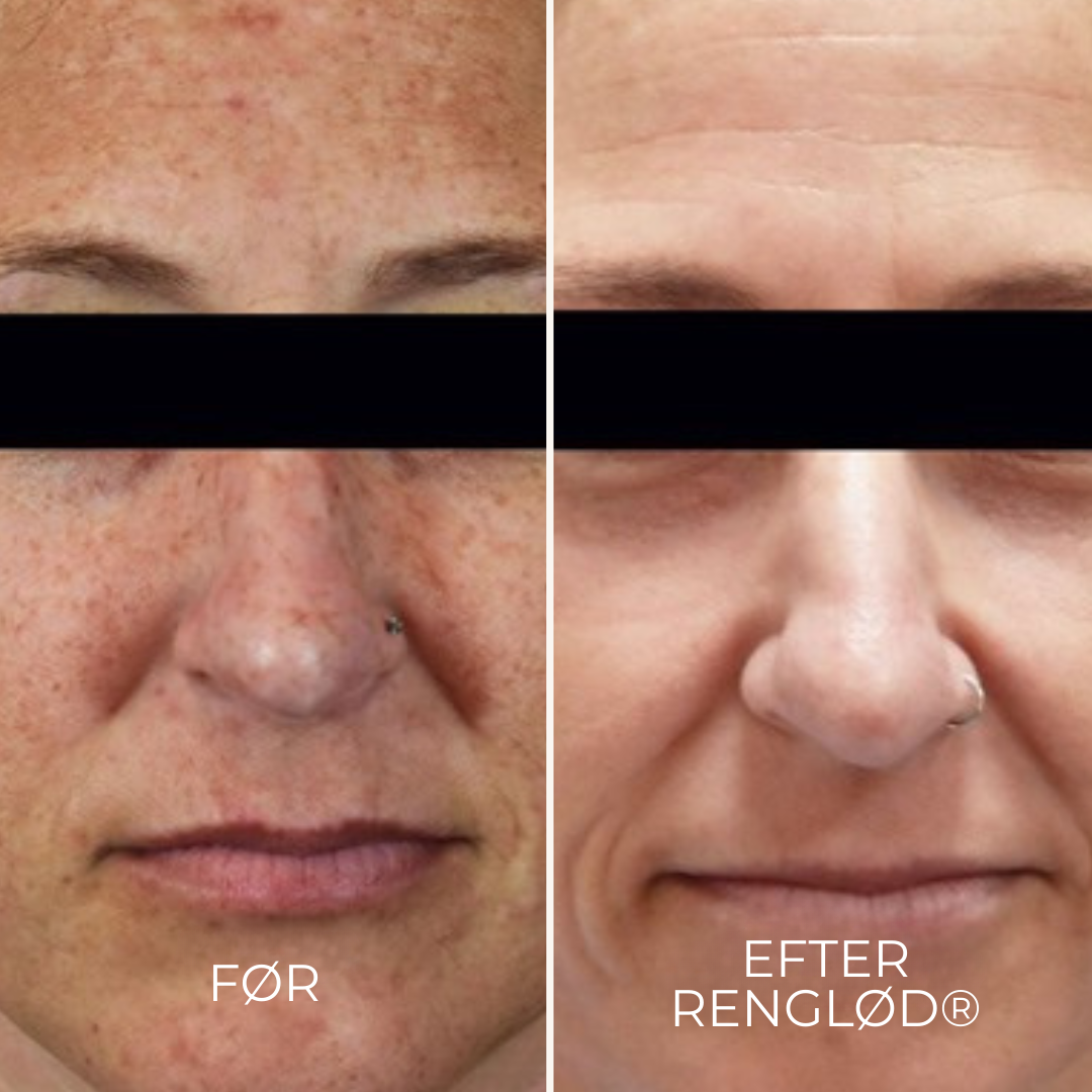 RenGlød® | Anti-Mørkeplet Creme