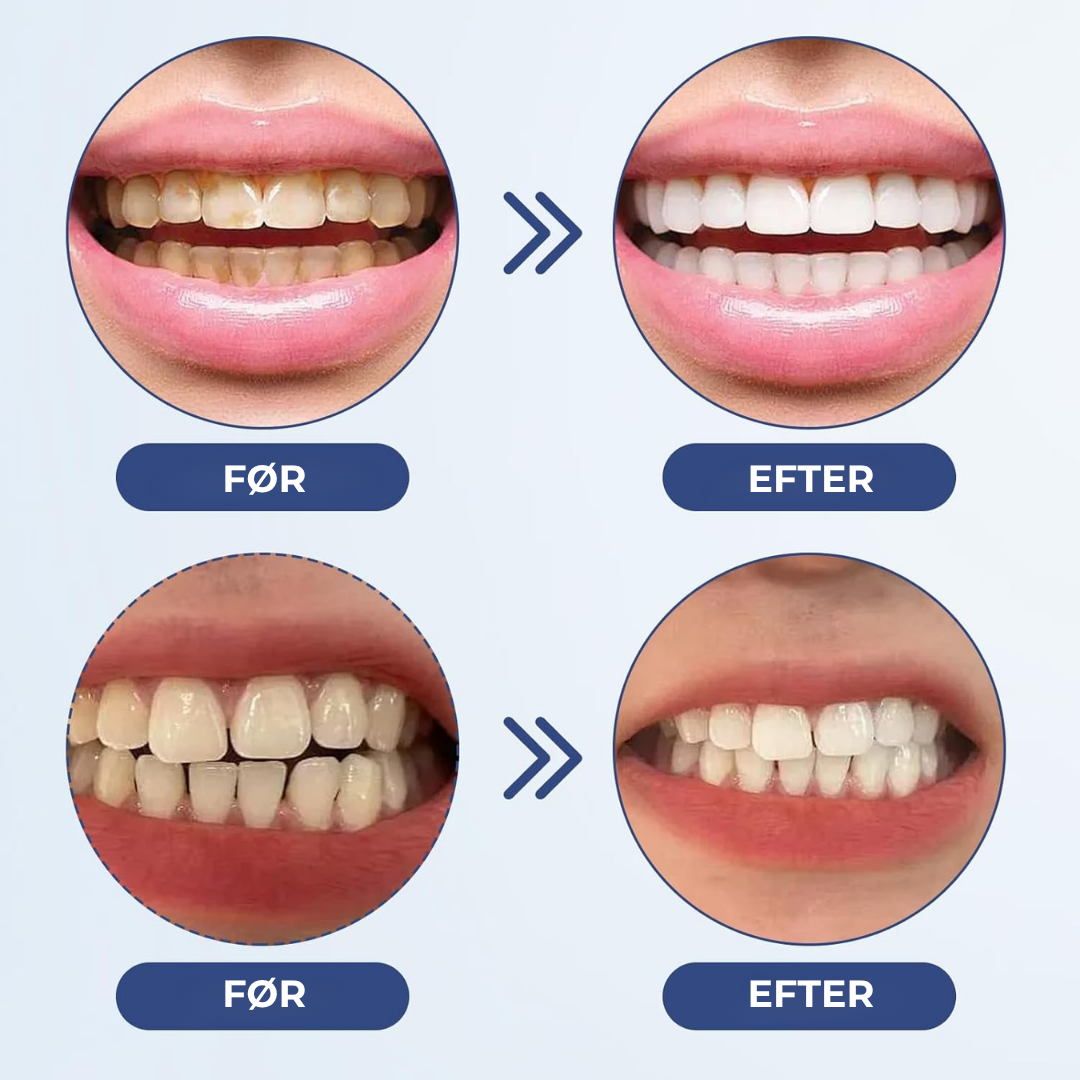 BlidGum® | Revitaliserer tilbagetrukket tandkød og hvidner gule tænder på kun 3 dage