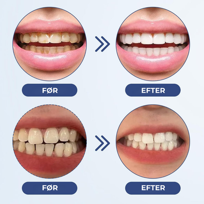 BlidGum® | Revitaliserer tilbagetrukket tandkød og hvidner gule tænder på kun 3 dage