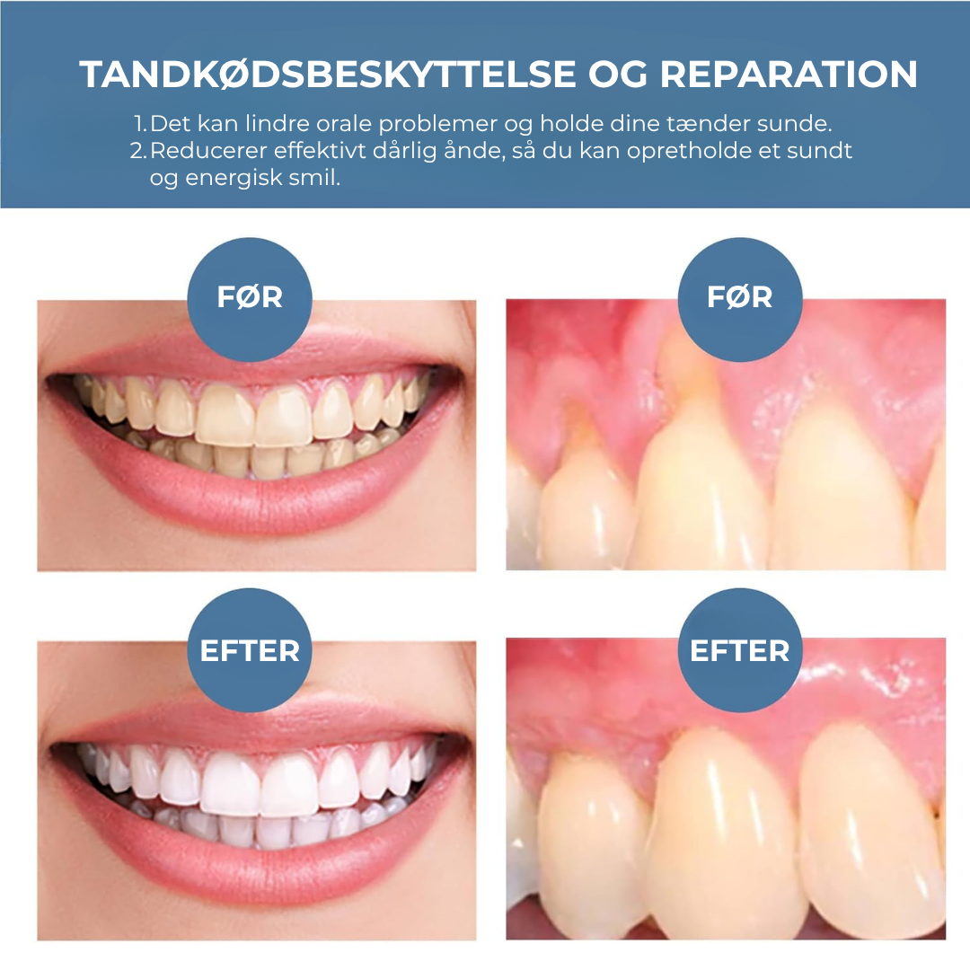 BlidGum® | Revitaliserer tilbagetrukket tandkød og hvidner gule tænder på kun 3 dage