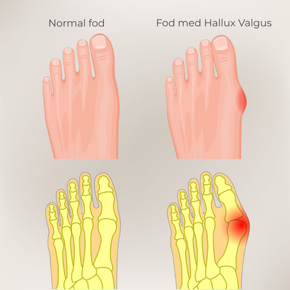FlexiToe® | Skånsom tåjustering for daglig lindring
