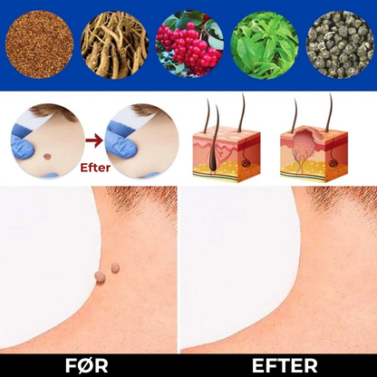 WartFri®
