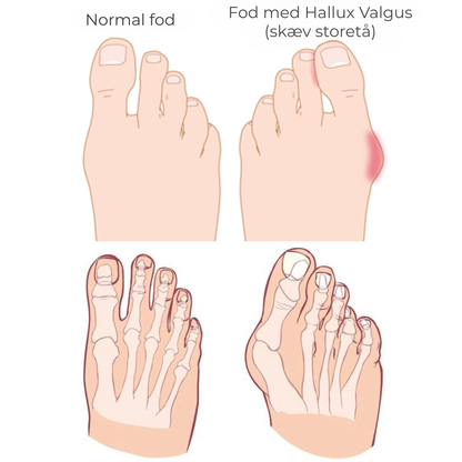 FlexiToe® | Skånsom tåjustering for daglig lindring