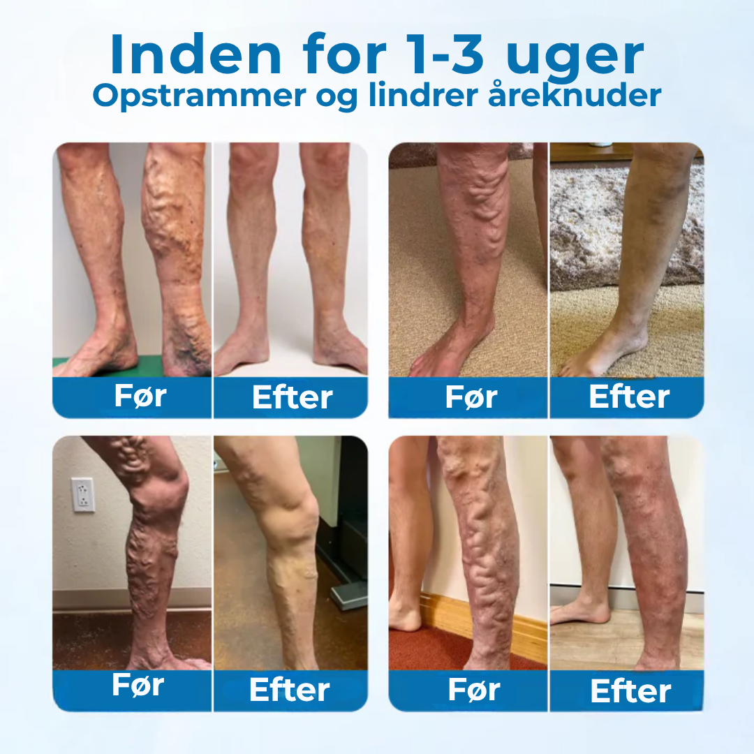 CircuClear® | Tag kontrollen over dine ben tilbage – synlig lindring på kun 1 uge