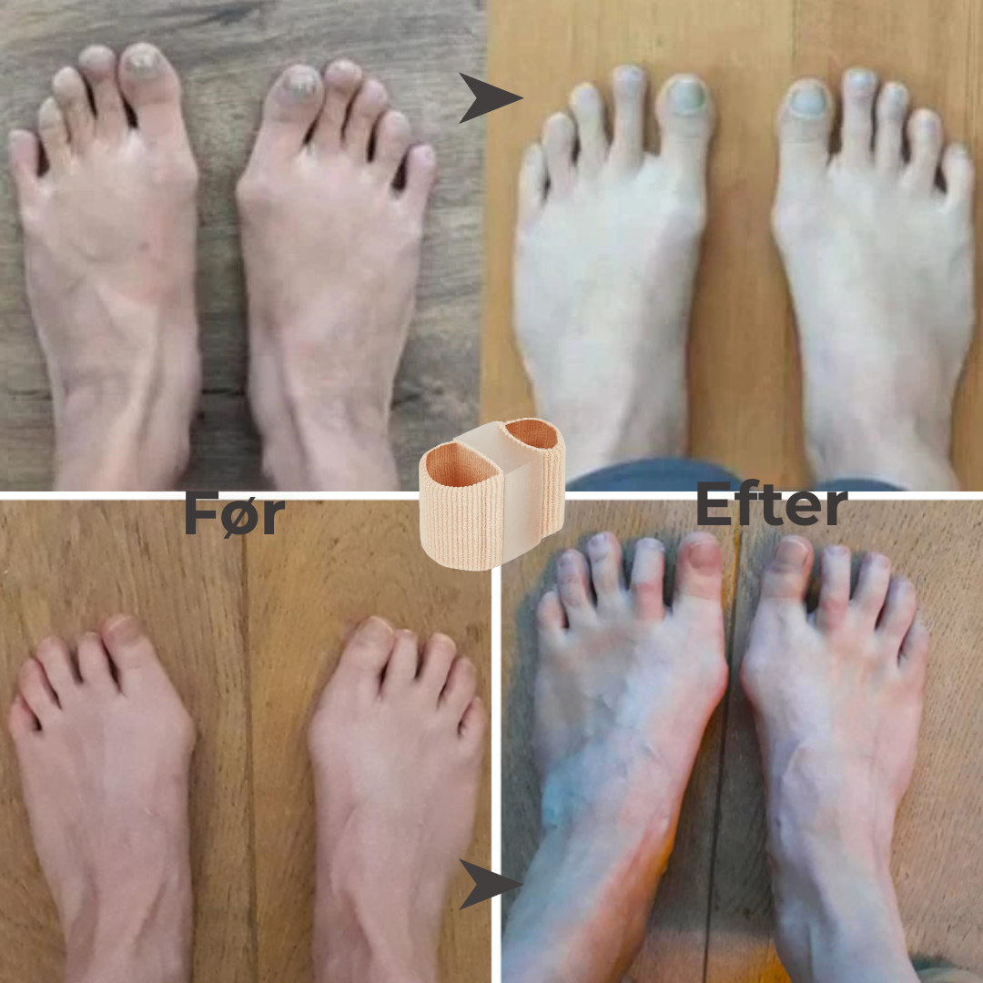 FlexiToe® | Skånsom tåjustering for daglig lindring