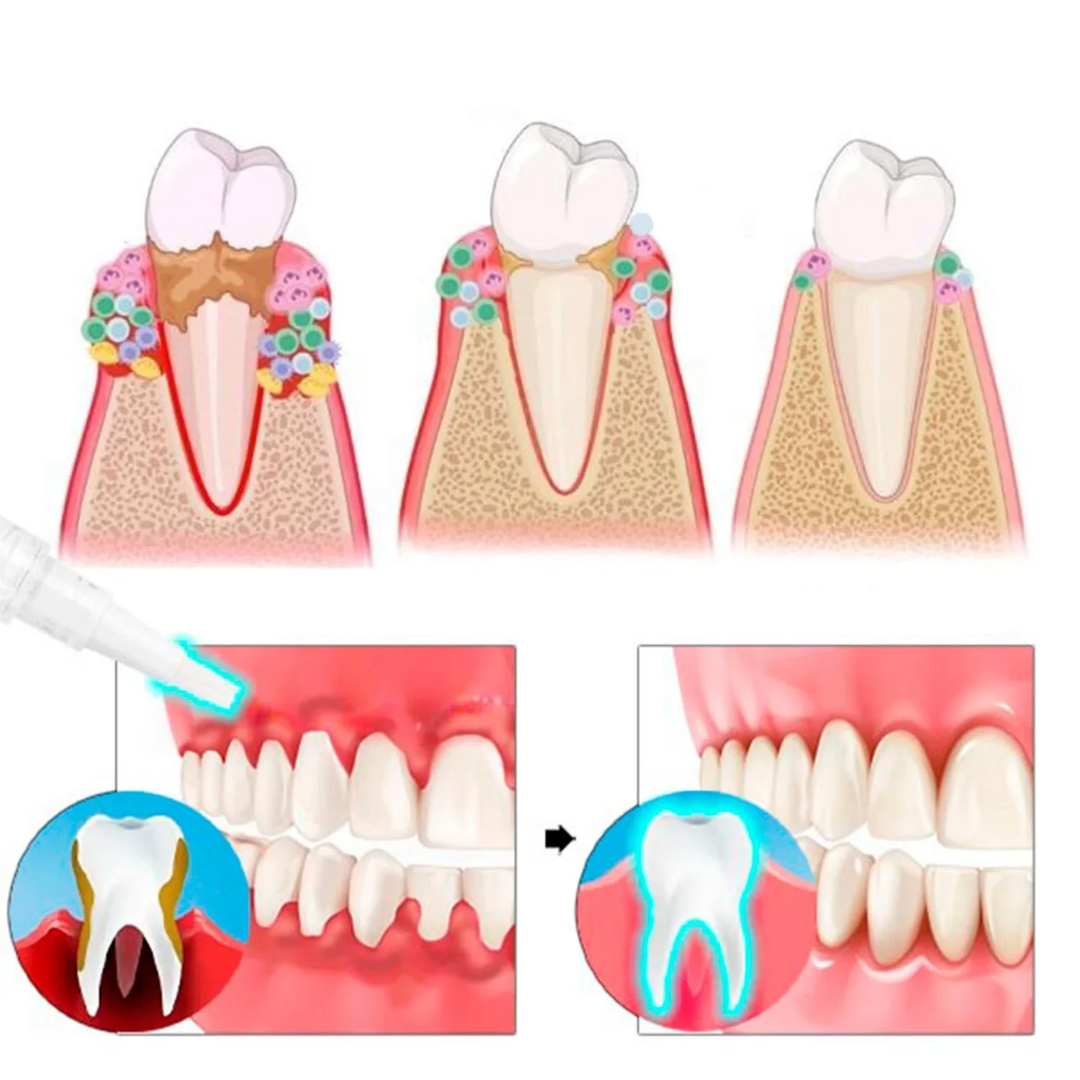 BlidGum® | Revitaliserer tilbagetrukket tandkød og hvidner gule tænder på kun 3 dage