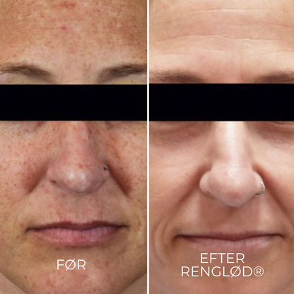 RenGlød® | Anti-Mørkeplet Creme