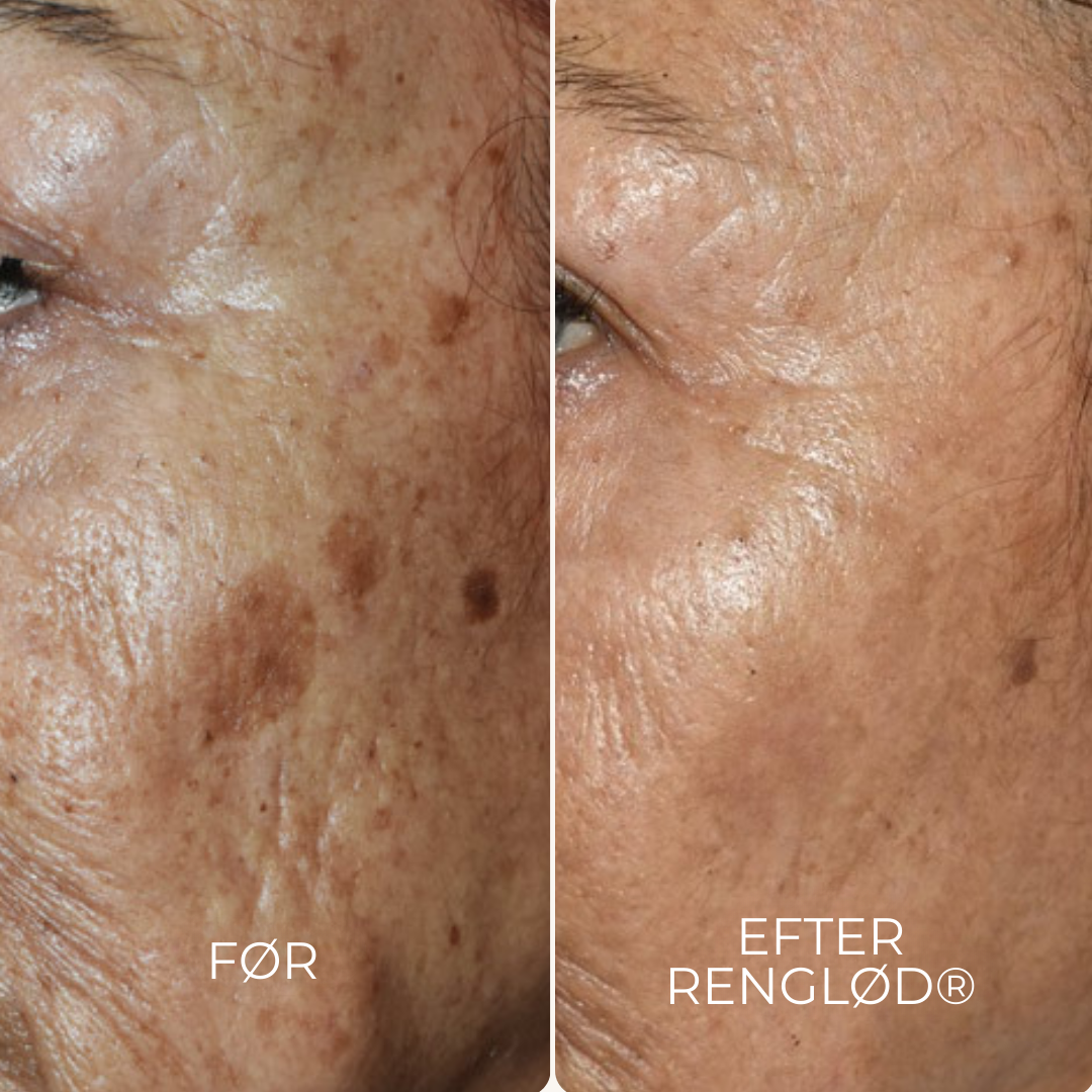 RenGlød® | Anti-Mørkeplet Creme