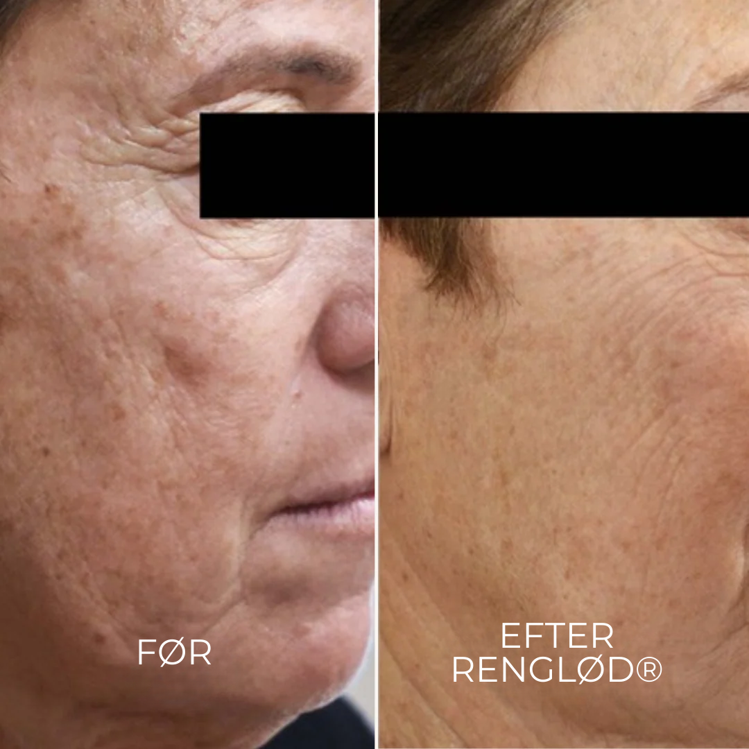 RenGlød® | Anti-Mørkeplet Creme